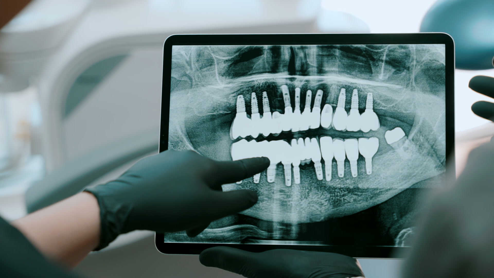 Implantate: Röntgenbild mit Implantaten auf dem Tablet